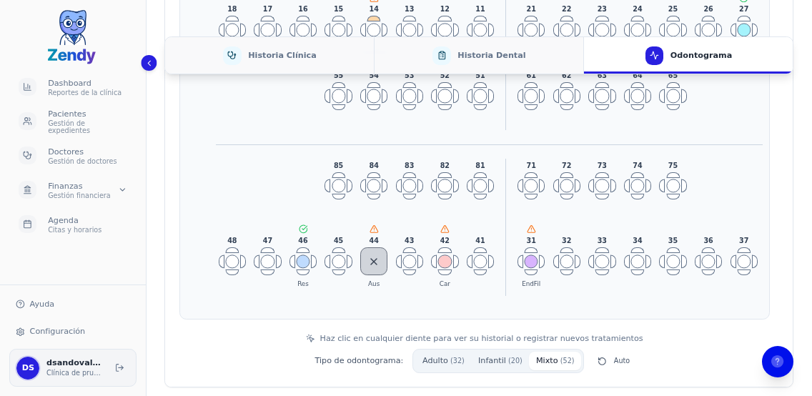 Vista del odontograma mixto mostrando 52 dientes